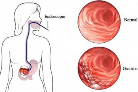 Chronic Gastritis – Causes, Symptoms, Ayurvedic treatment, Herbal Remedies, Diet & Lifestyle Chronic Gastritis – Causes, Symptoms, Ayurvedic treatment, Herbal Remedies, Diet & Lifestyle