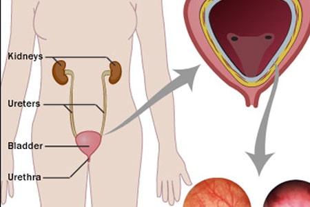 Cystitis – Causes, Symptoms, Ayurvedic Treatment, Herbal Remedies
