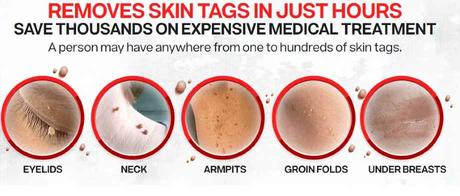 Skin Tag Removal Cream - Picture of Skin Tags 