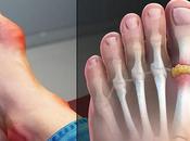 Herbal Remedies Gout