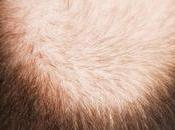 Herbal Remedies Ayurvedic Treatment Baldness