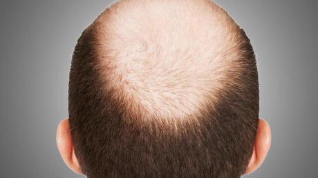 Herbal Remedies for Ayurvedic Treatment of Baldness