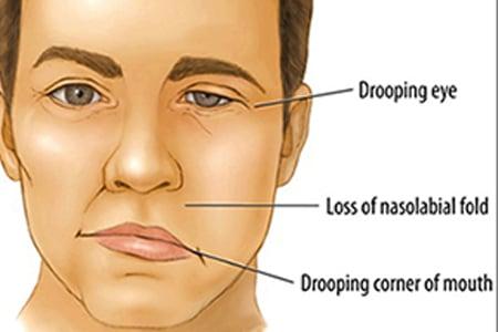 Facial Paralysis (Ardita)