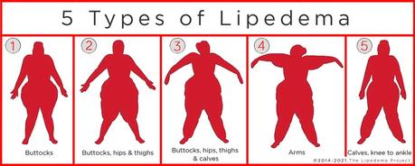 Heavy hips and legs – could you have lipedema?