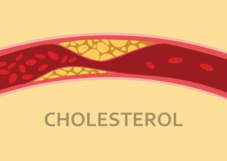 Ayurvedic Treatment for High Cholesterol – Causes, Symptoms, Herbs, Diet & Lifestyle