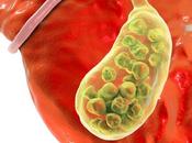 Herbal Remedies Gallstones