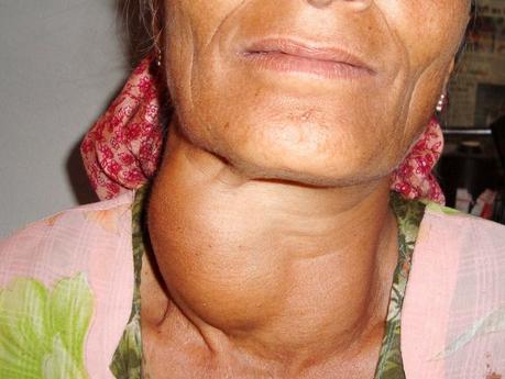 Ayurvedic treatment for Goitre