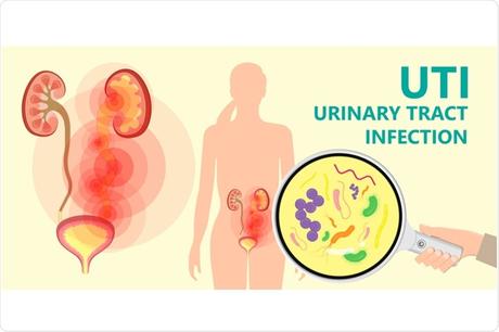URINARY TRACT INFECTION