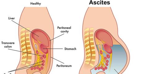 Ascites (Jalodar)