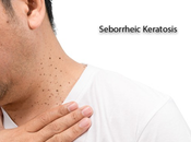 Ayurvedic Treatment Seborrheic Keratosis