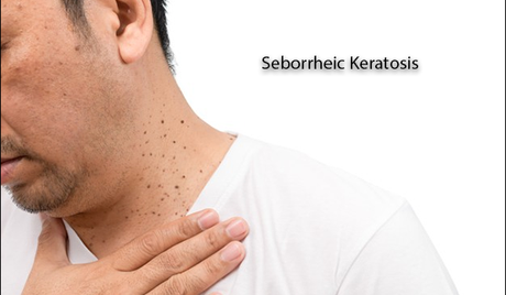 Ayurvedic Treatment of Seborrheic Keratosis