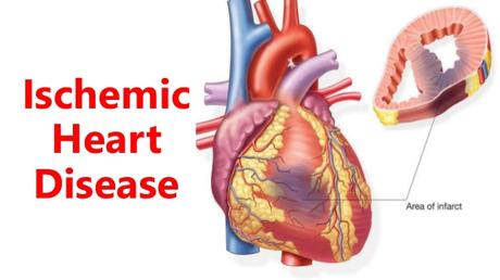 Ischemic Heart Disease – Herbal Remedies and Ayurvedic Treatment