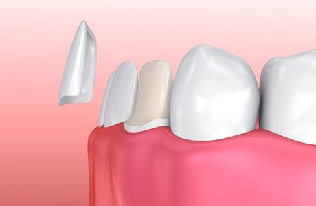 Dental veneers