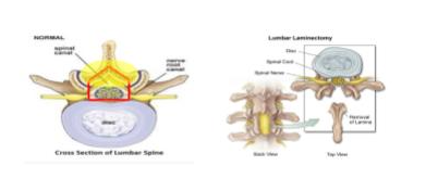 Alternatives to Laminectomy