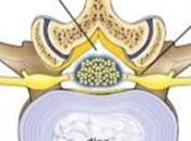 Alternatives Laminectomy