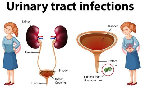UTI (Urinary Tract Infection)