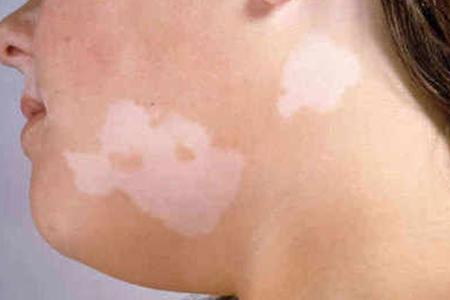 Herbal Remedies for Leucoderma