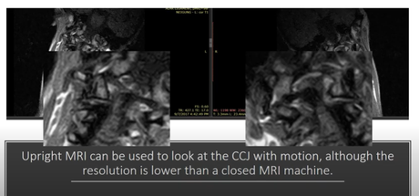 The quality of the imaging for upright MRI is lower than the standard MRI