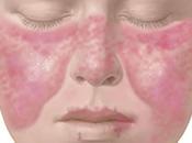 Ayurvedic Treatment Systemic Lupus Erythematosus (SLE)