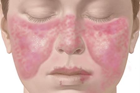 Ayurvedic Treatment of Systemic Lupus Erythematosus (SLE)