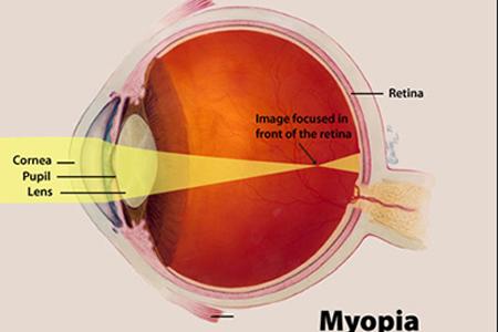 Herbal Remedies for Myopia