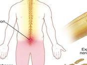 Herbal Remedies Multiple Sclerosis (MS)