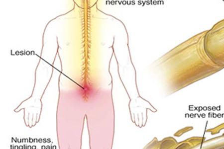 Herbal Remedies for Multiple Sclerosis (MS)