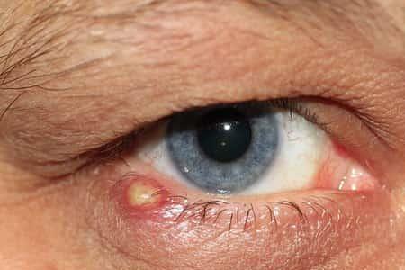 Herbal Remedies for Stye