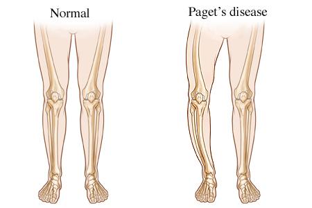 Herbal Remedies for Paget’s Disease