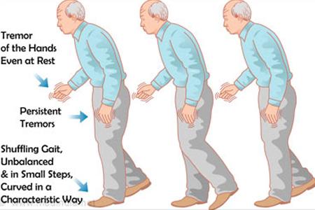 Herbal Remedies for Parkinson’s Disease