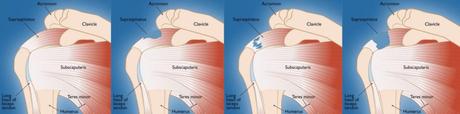 Types of tears - rotator cuff tear relief without surgery