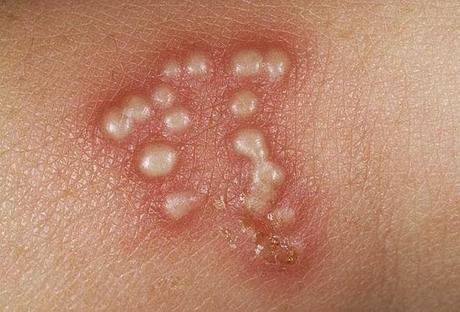 Herbal Remedies for Herpes Zoster (Shingles) Herbal Remedies for Herpes Zoster (Shingles)