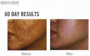 Rodan + Fields UNBLEMISH Review