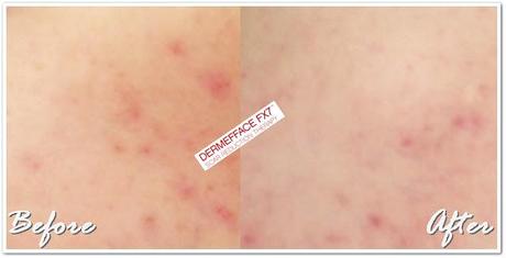 Dermefface FX7 Scar Reduction Therapy Review