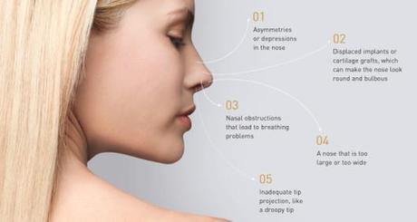 Top Causes for Revision Rhinoplasty
