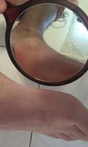 Skin Cancer And Your Feet