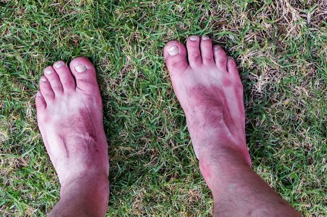 sunburnt feet