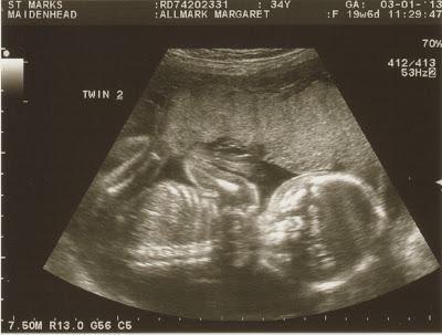 My Twin Pregnancy - Week 20