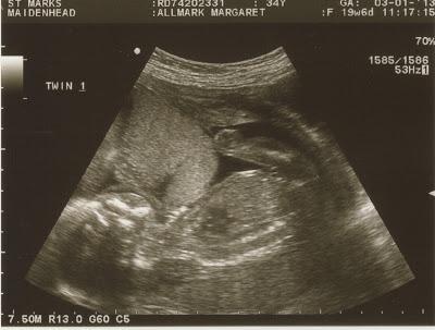 My Twin Pregnancy - Week 20