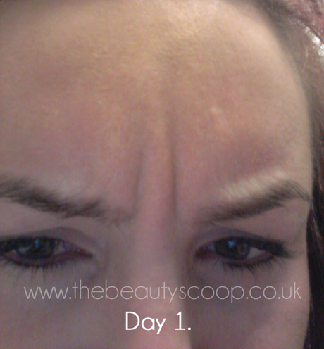 The Botox Diaries - Days 1 to 4!