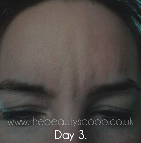 The Botox Diaries - Days 1 to 4!