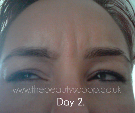 The Botox Diaries - Days 1 to 4!