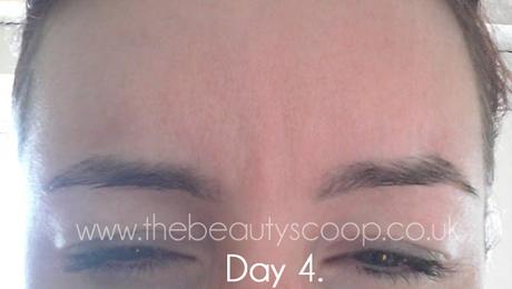 The Botox Diaries - Days 1 to 4!