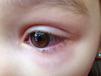 Conjunctivitis Strikes Again... Times Three!