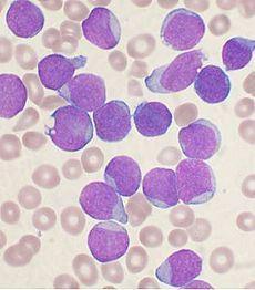 Leukemia Cells are seen here as large and purple; the smaller pale red ones are RBCs