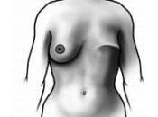 After Mastectomy Bilateral