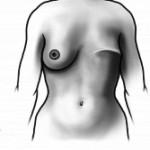 after a mastectomy