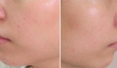 Flash Review: Garnier PureActive Anti-Imperfections Roll-On