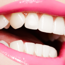 Quick Fix – Teeth Whitening