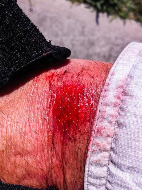 abrasion on top of wrist bleeding 